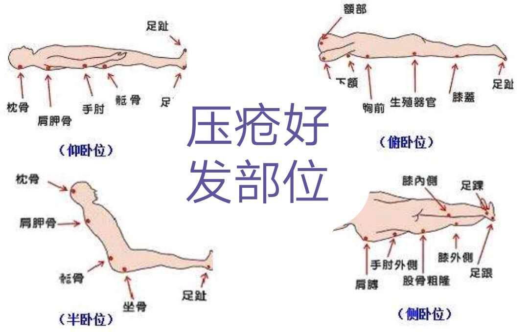 最新壓瘡護理措施的研究與應用進展